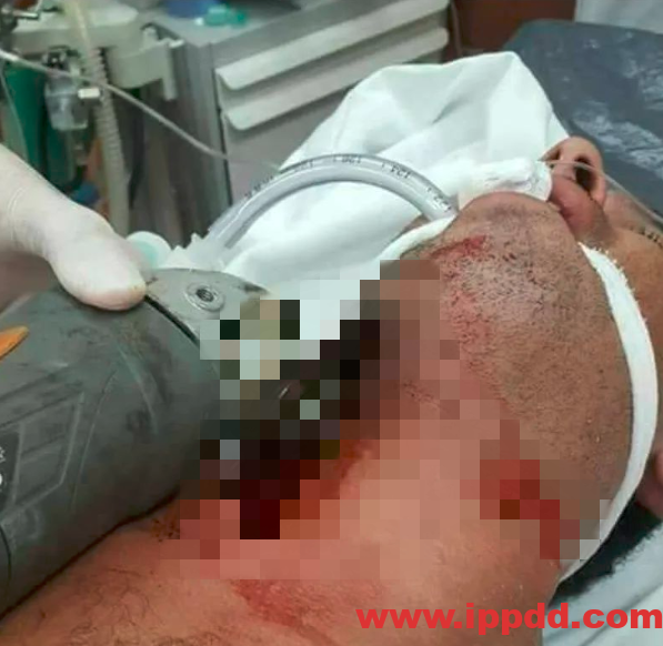 【砂轮机事故】脖子被切!不要再问为什么要安防护罩!